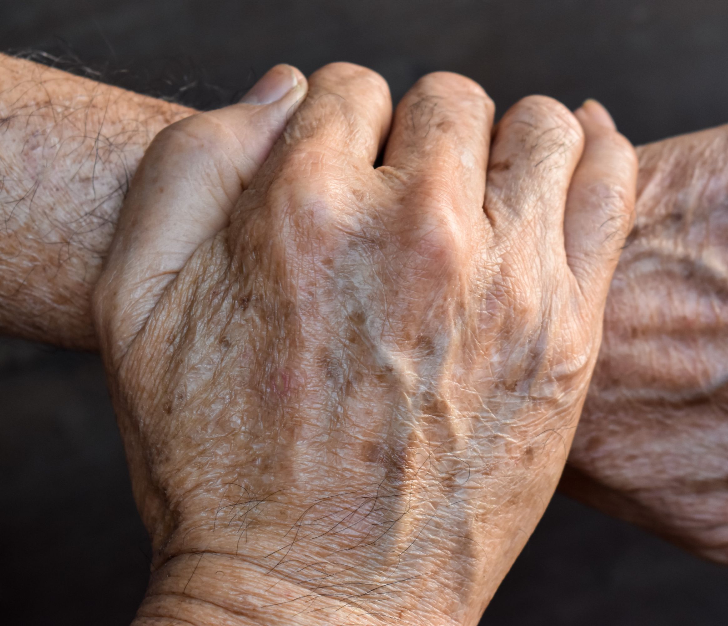 Taches solaires de vieillesse sur les mains