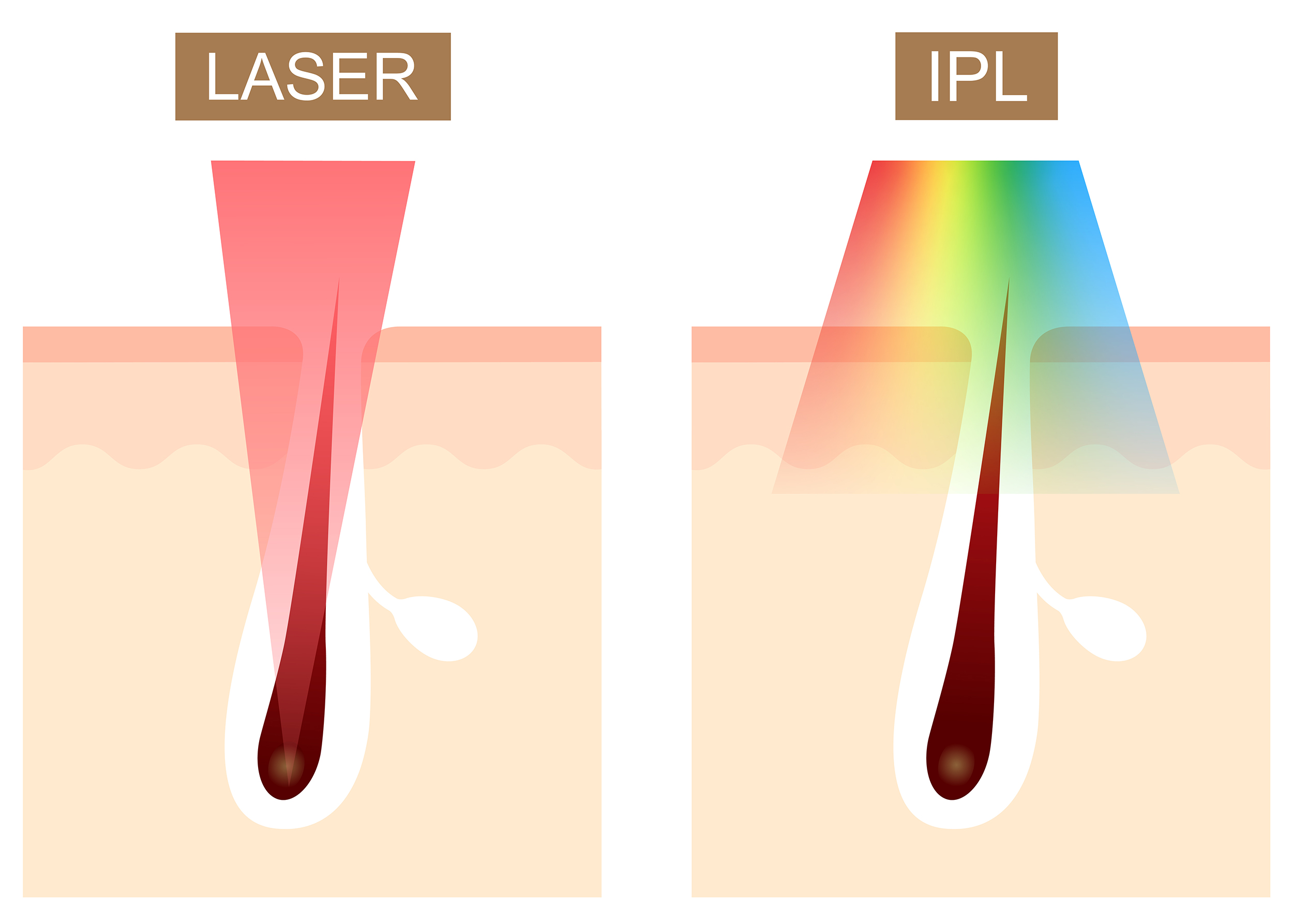Epilation laser Vs IPL